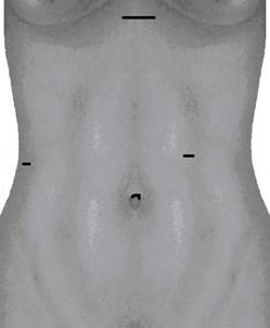 Klassische MIC OP-Variante mit dem Bergeschnitt direkt unter dem Brustbein