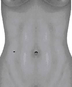 Notes-Operation - Hier liegt der Bergeschnitt in der Scheide und am Bauch sind nur 1-2 sichtbare sehr kleine Narben von 2-3mm