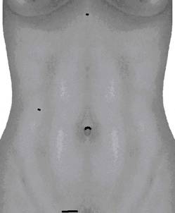 Mikro-Schnitte von 2-3mm am Bauch mit Bergeschnitt im Schaamhaarbereich